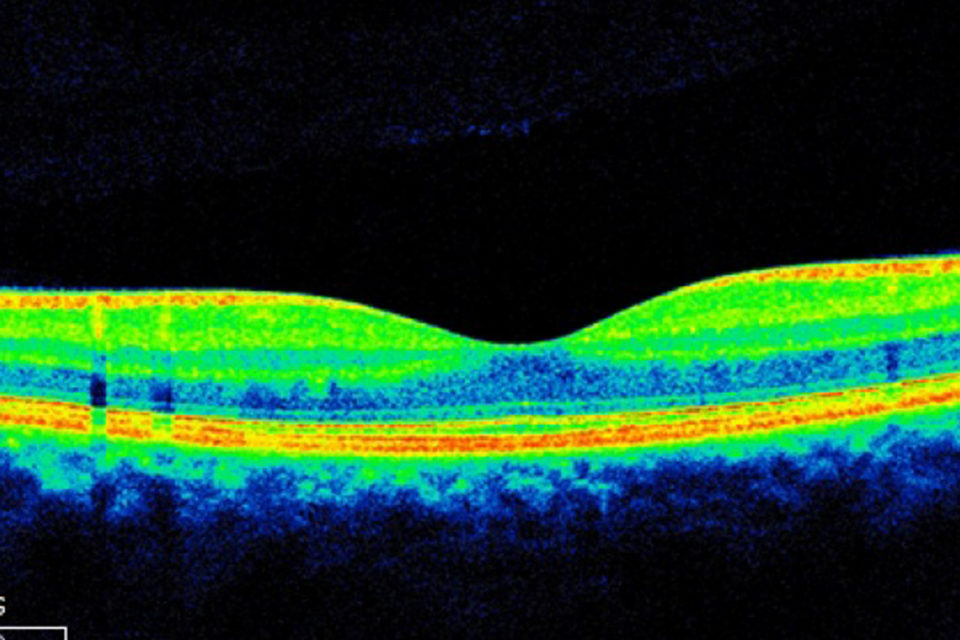 Image of a retina by optical coherence tomography